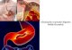 Afecțiunile tractului digestiv. Bolile . · PDF file 2020. 11. 4. · Cancerul gastric este precedat cel mai frecvent de stăride precancer ca ulcerul gastric cronic (ulcer-cancer),