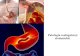 Patologia esofagului și stomacului. · 2021. 2. 19. · Ulcerul gastric peptic de obicei este solitar (80%), localizat mai frecvent înregiunea micii curburi și antro-pilorică.